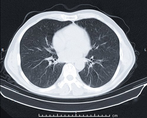 image of lungs ct scan