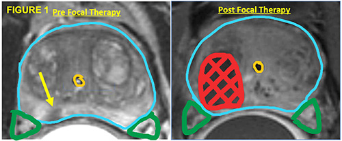 X-rays of prostate cancer therapy results