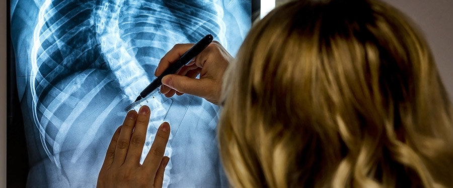 A doctor marks an x-ray of the curve of the spine of a scoliosis patient to prep for minimally invasive surgery.