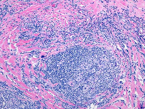 Hodgkin lymphoma biopsy