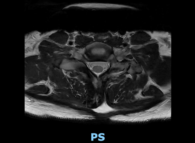 Postop axial mri