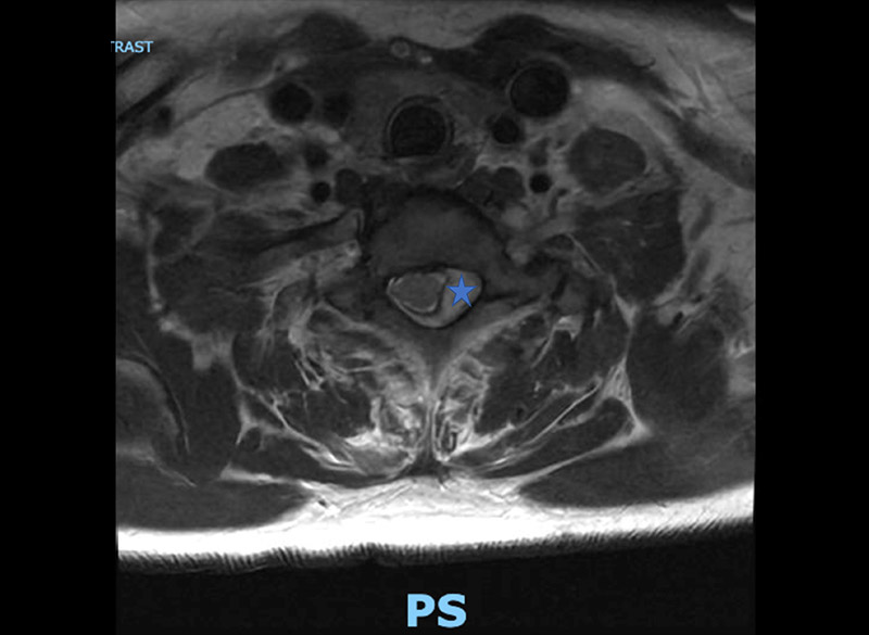 preop axial mri