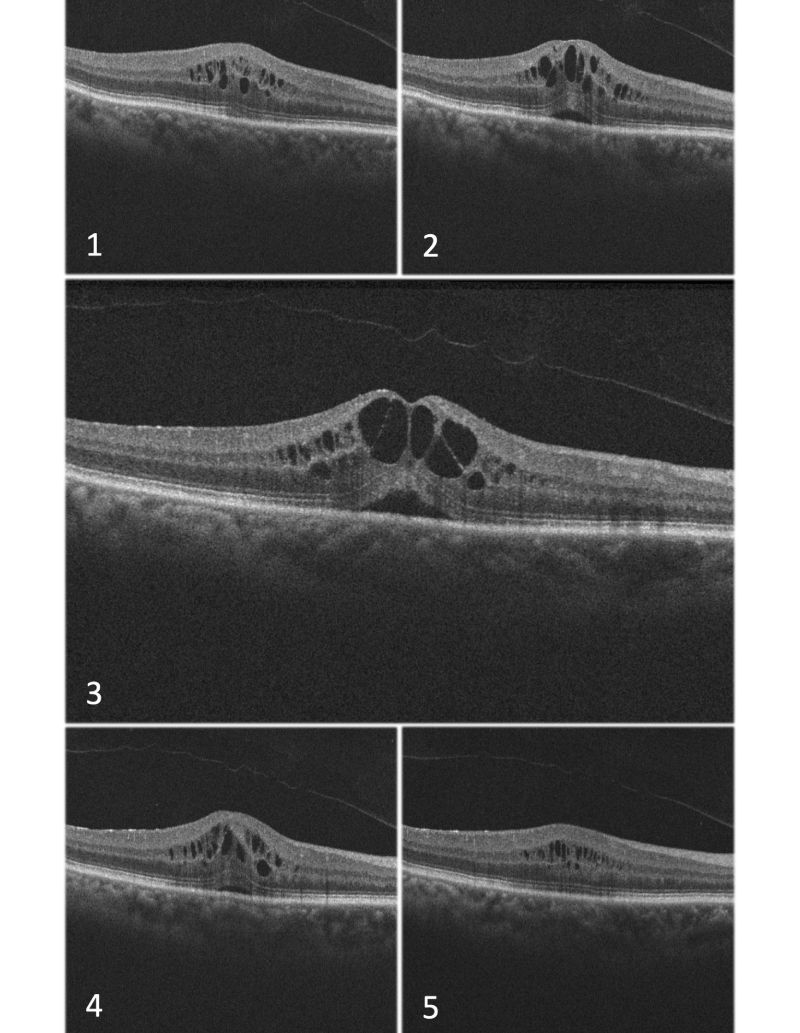 cme with optically empty areas