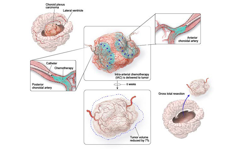 image of the intra-arterial chemotherapy protocol and results from subsequent surgery