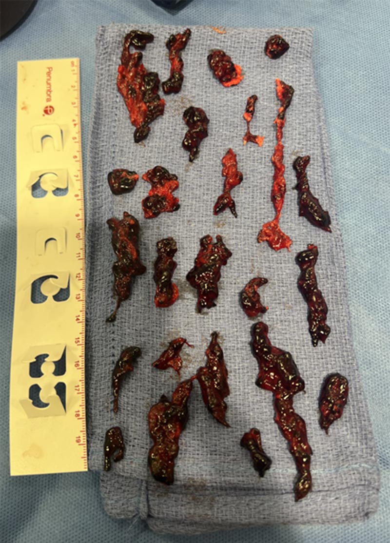 Remnants of the blood clot after the mechanical thrombectomy