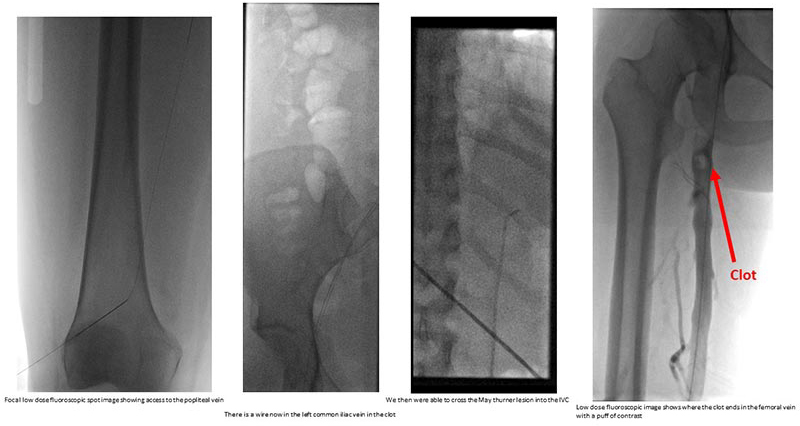 Right iliac artery compressing the left iliac vein