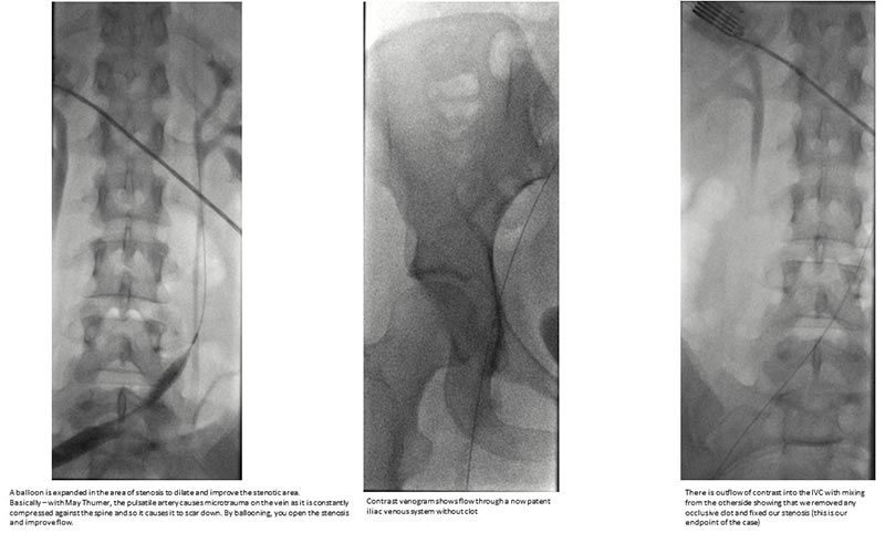 Successful clot evacuation