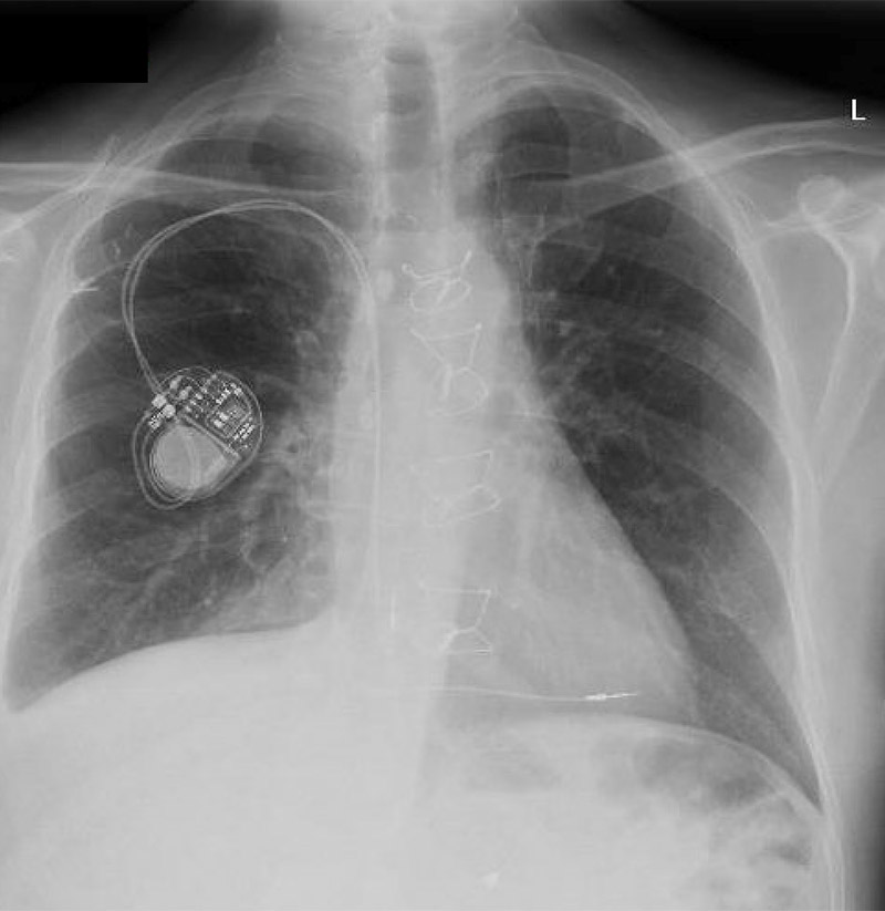 chest x-ray