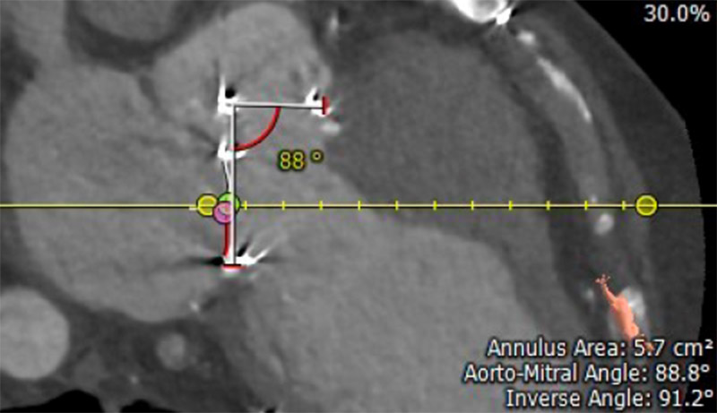 3-D CTA reconstruction of a post-Commando patient