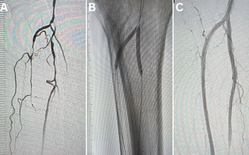 Pre-and-post angiogram photos