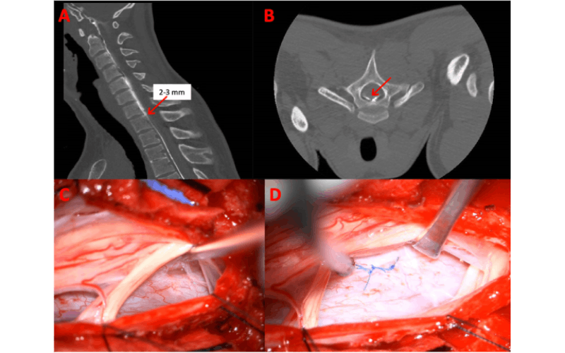 Images from a hyperdynamic multiphase prone CT myelogram