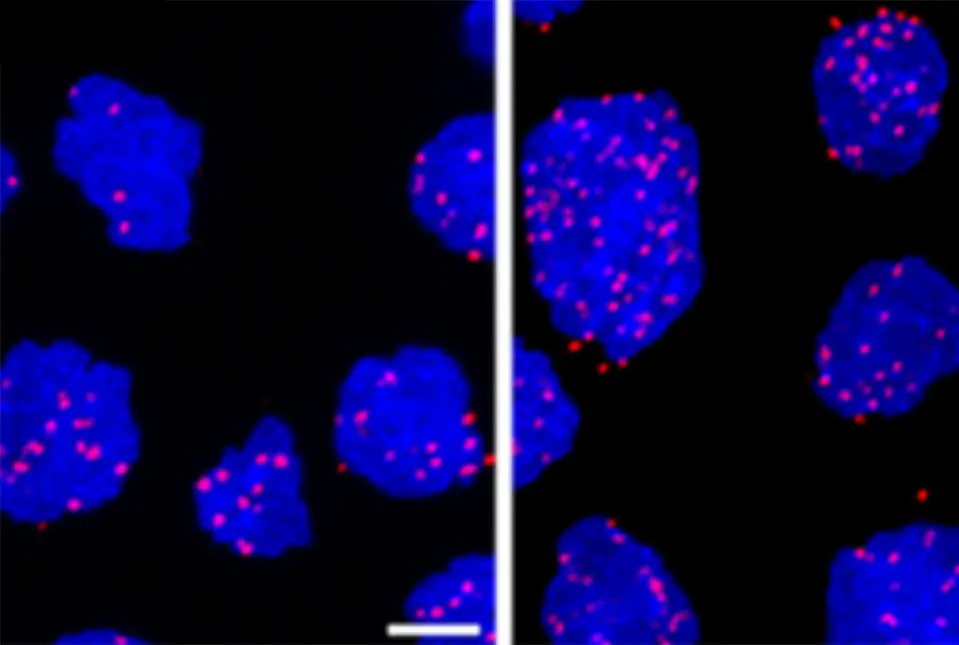 B cell Lymphoma cells 