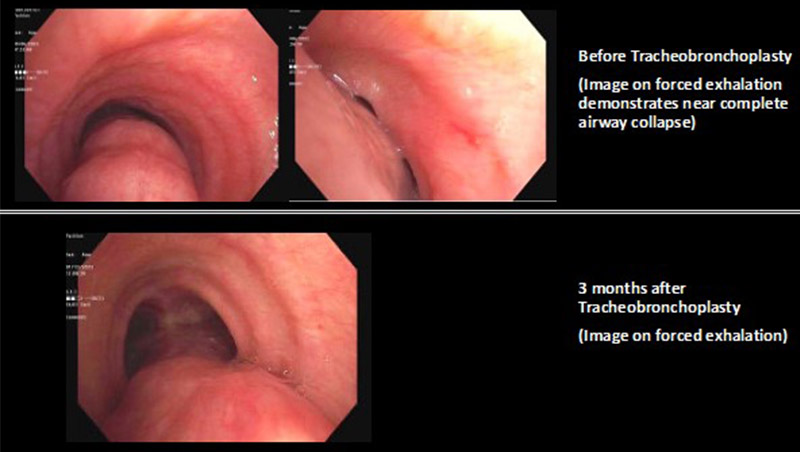 Dynamic bronchoscopy