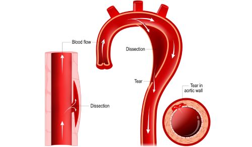 Type B Dissections in Marfan Syndrome Are Associated with a More Severe Phenotype