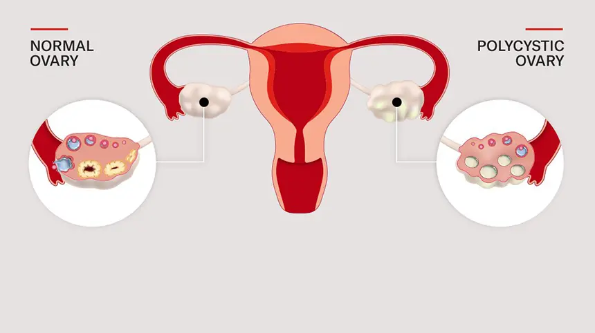 What is Polycystic Ovary Syndrome (PCOS)?