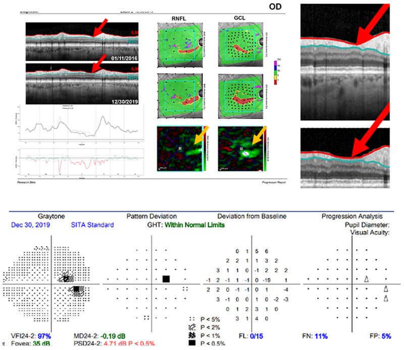 tomography of optic disc