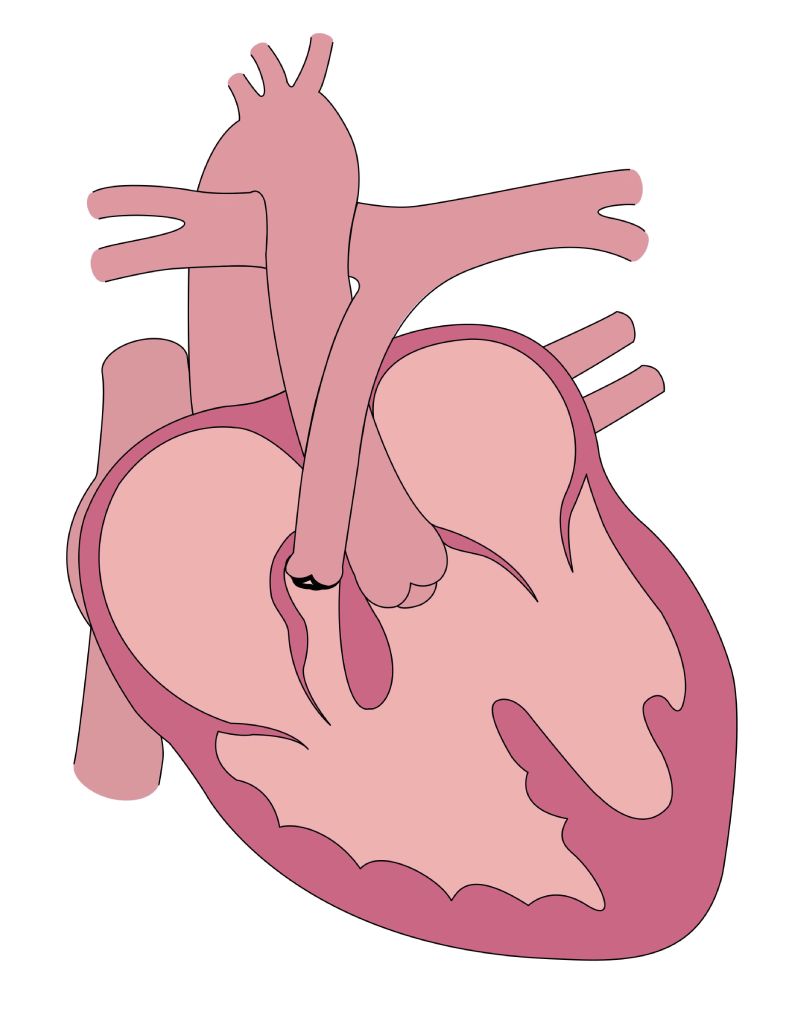 Illustration of tetralogy of Fallot