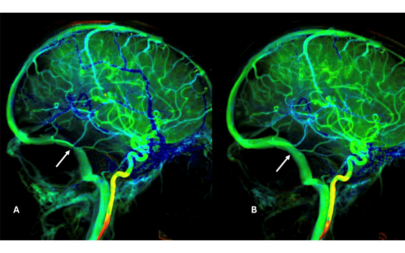 Lateral view of brain angiogram showing before and after stenting