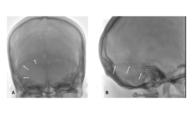 Right sided venous sinus stent