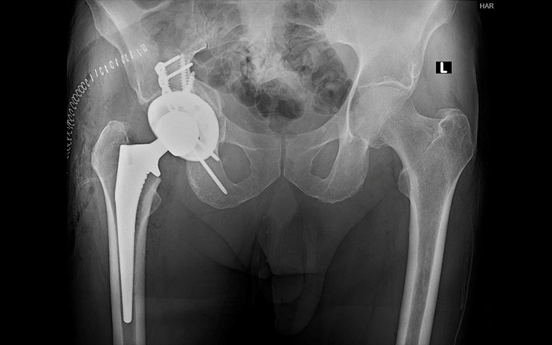 xray of surgical treatment for geriatric acetabular fracture