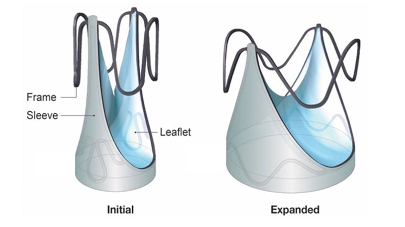 3D rendering of the Autus Size-Adjustable Valve