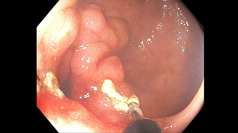 Utilizing EIT to perform a stricturotomy 