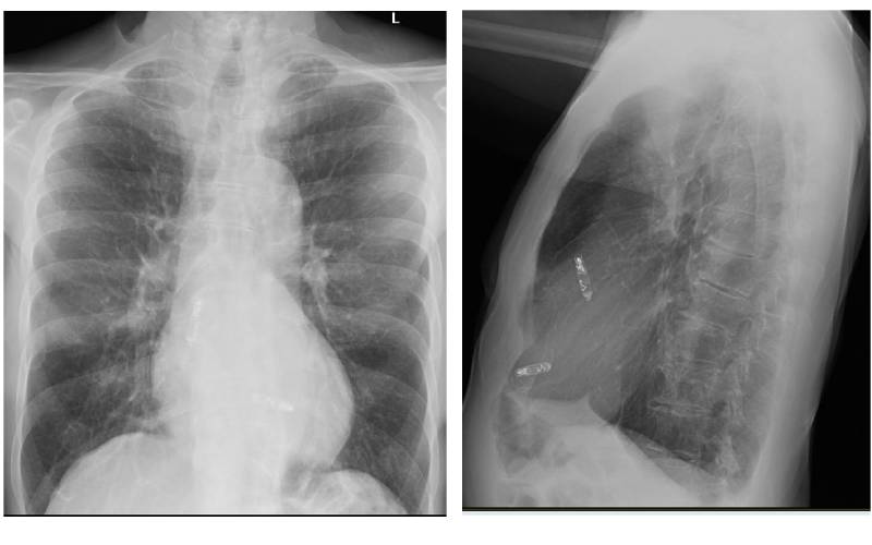 Chest x-ray with pacemaker