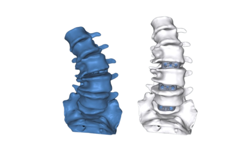 AI-generated patient-specific 3D spine models of a patient’s pre-operative spine (blue) and the personalized planned alignment (white)