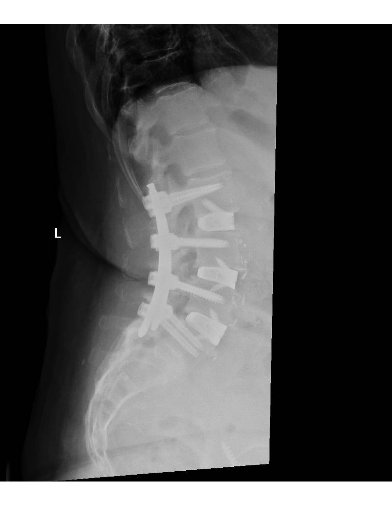 X-ray showing the interbody case implanted into a patient