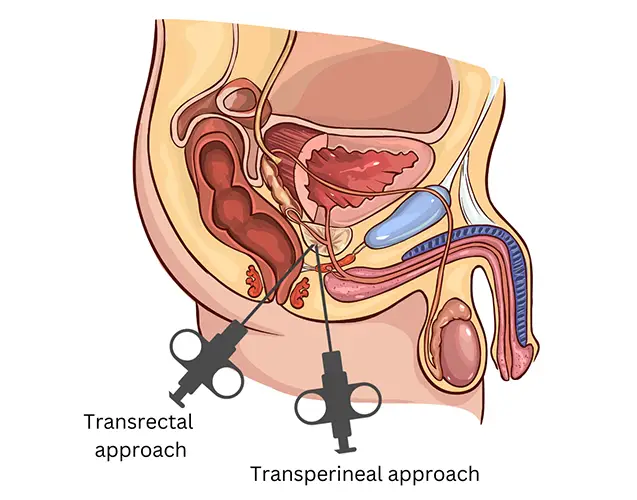 Drawing of the male reproductive system with black needles showing biopsy approaches through rectum and perineum.