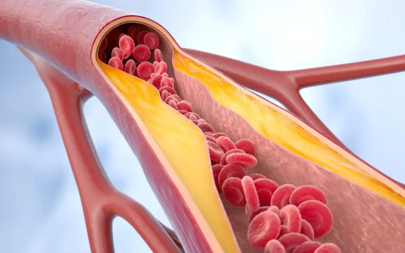 A build up of substances narrowing the artery walls, blocking blood flow.