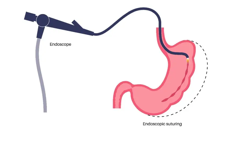 endoscopic illustration