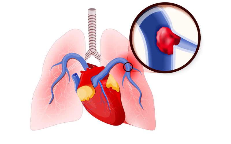 Illustration of pulmonary embolism