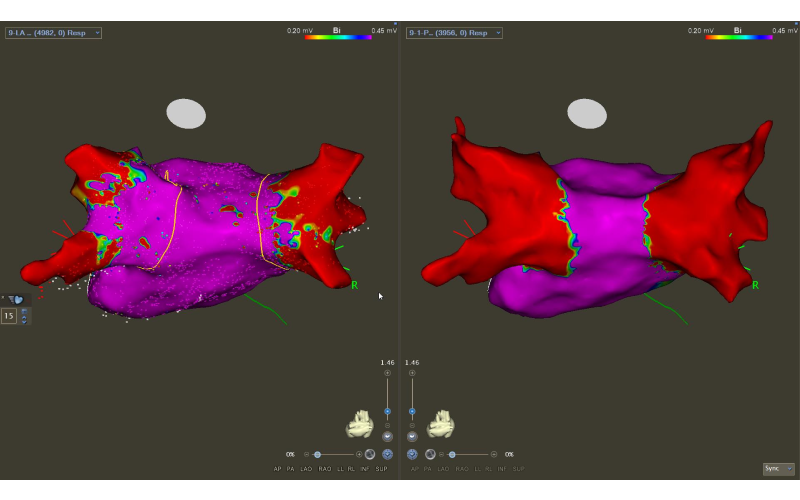 Left atrium electrical activity