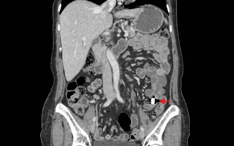 CT imaging showing lodged capsule