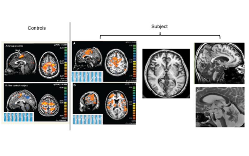 First CMD patient analysis