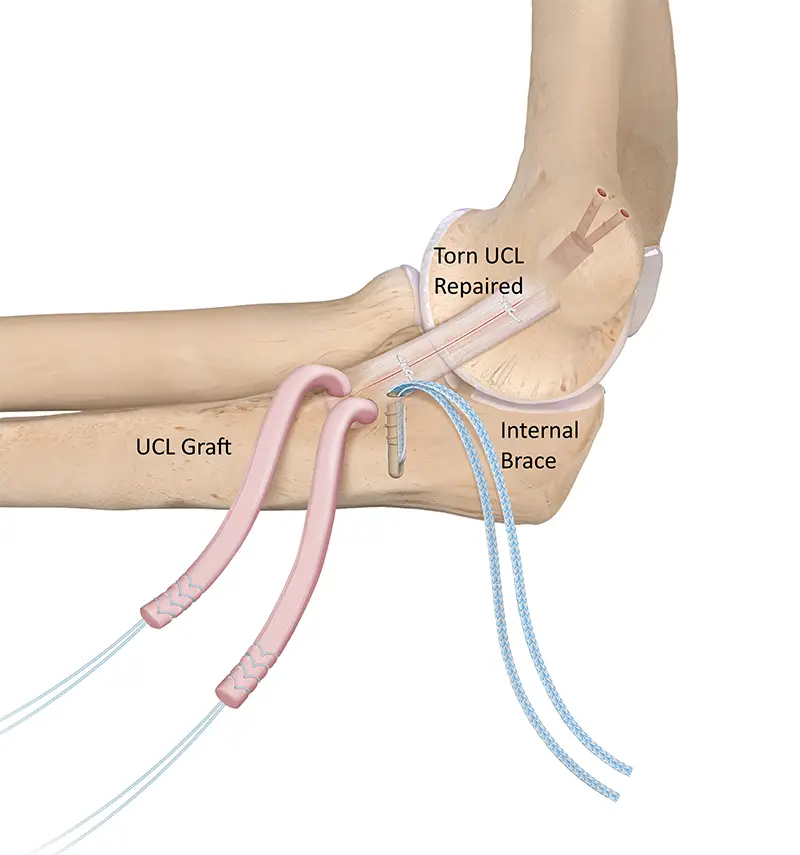 illustrated image of Triple Tommy John procedure