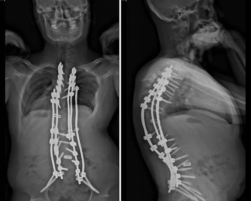 X-rays nine weeks after Chinno’s surgery show his kyphosis and scoliosis significantly improved.