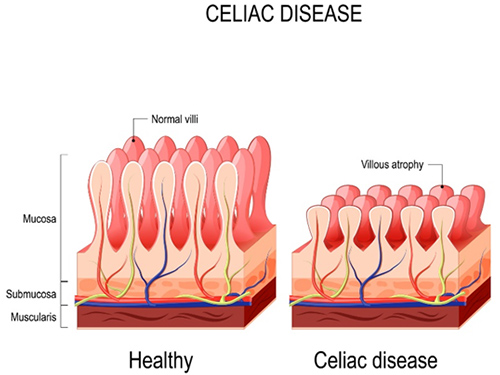 vector illustration of normal villi and villous atrophy in the small bowel